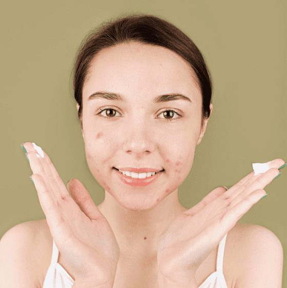 7 Confidence-Boosting Strategies for Acne-Prone Skin