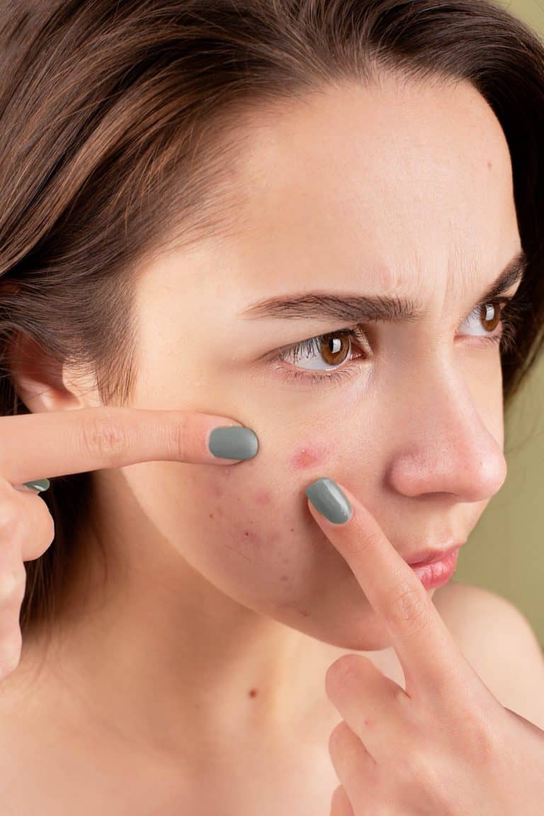 Fade Acne Scars Fast: Discover the 4 Factors That Impact Healing Time