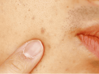 the Best Way to Fade Dark Spots fast from Pimples