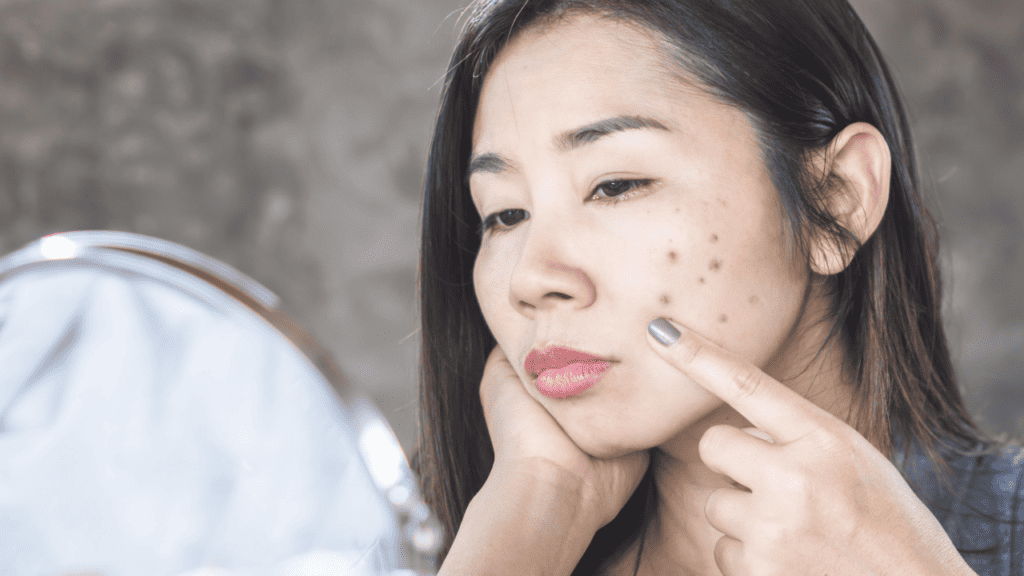 Fade Dark Spots from Pimples