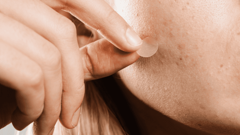 Best 6 Microdart Pimple Patches [2024]