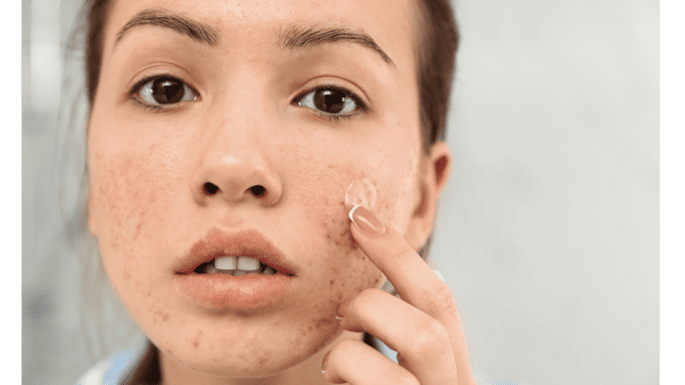 6 Best Microdart Patches for Cystic Acne in 2024