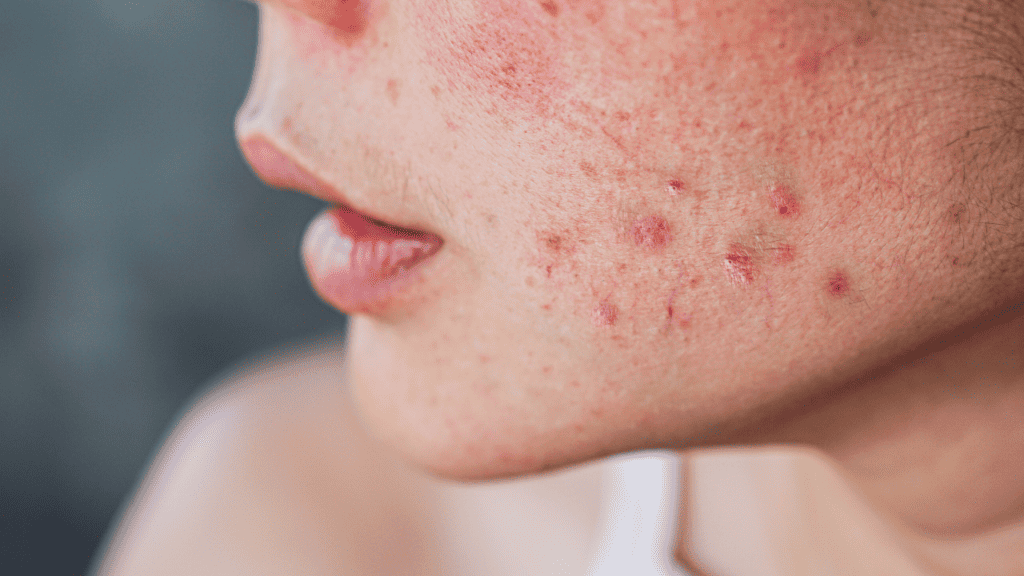 Why did the Pimple Patch Leave a Red Mark on My Face? - Skincare ...