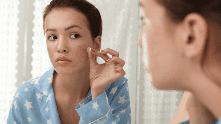 How to Remove Pimple Patch Residue from Skin: Micellar Water vs Rubbing Alcohol