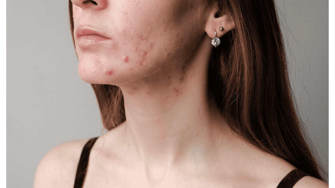 skincare - Hormonal Acne