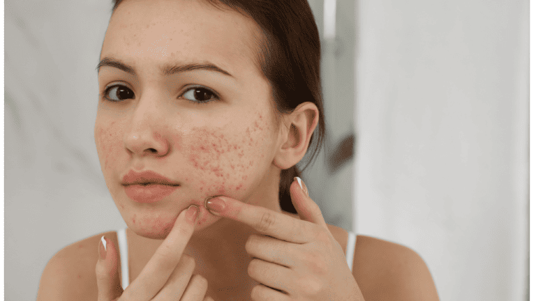 Why Do Pimples Cluster? Explained by Dermatologists