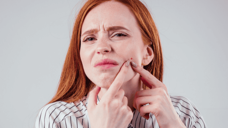 How to Deal with a Painful Blind Pimple: Don’t Pop it Yet