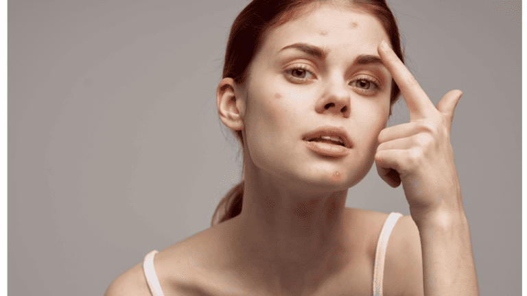 Best Skincare Brands for Acne Prone Skin in 2024