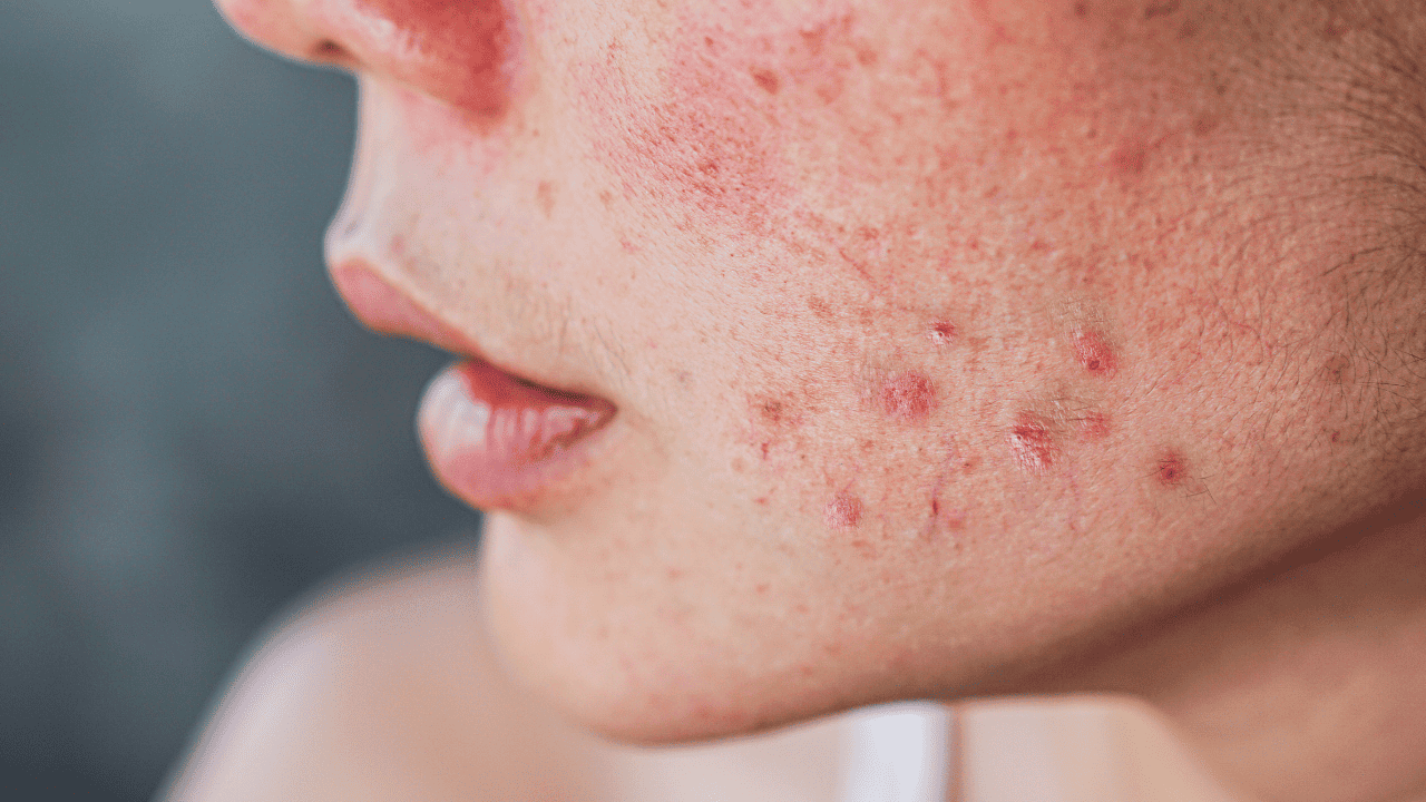 skincare - Redness & Inflammation