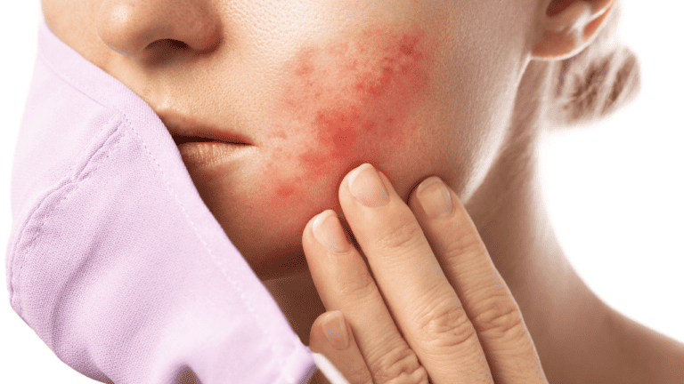 Effective Remedies for Treating Chemical Burns on Face Caused by Skincare Products