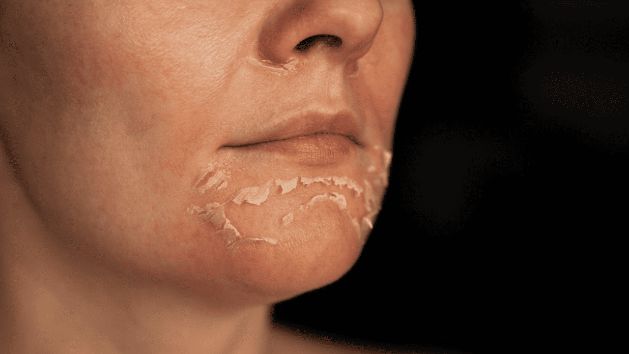 skincare - face peel