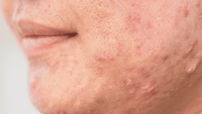 How To get rid of Keloid Scars?