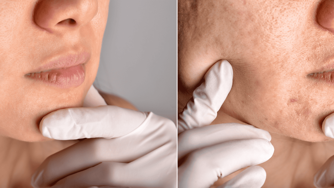 How To Get Rid Of Icepick Scars
