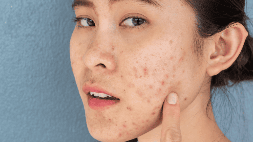When to Ice Your Pimples