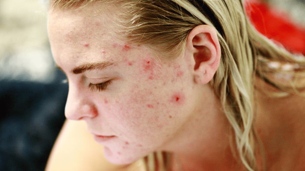 acne under sun